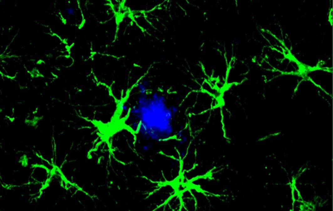 As VA Looks Ahead to Dementia Needs, Study Finds Immune Cells Attack ...